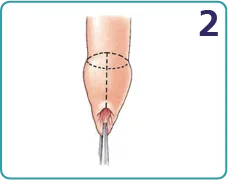 Traditional circumcision step 2