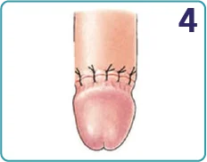Traditional circumcision step 4